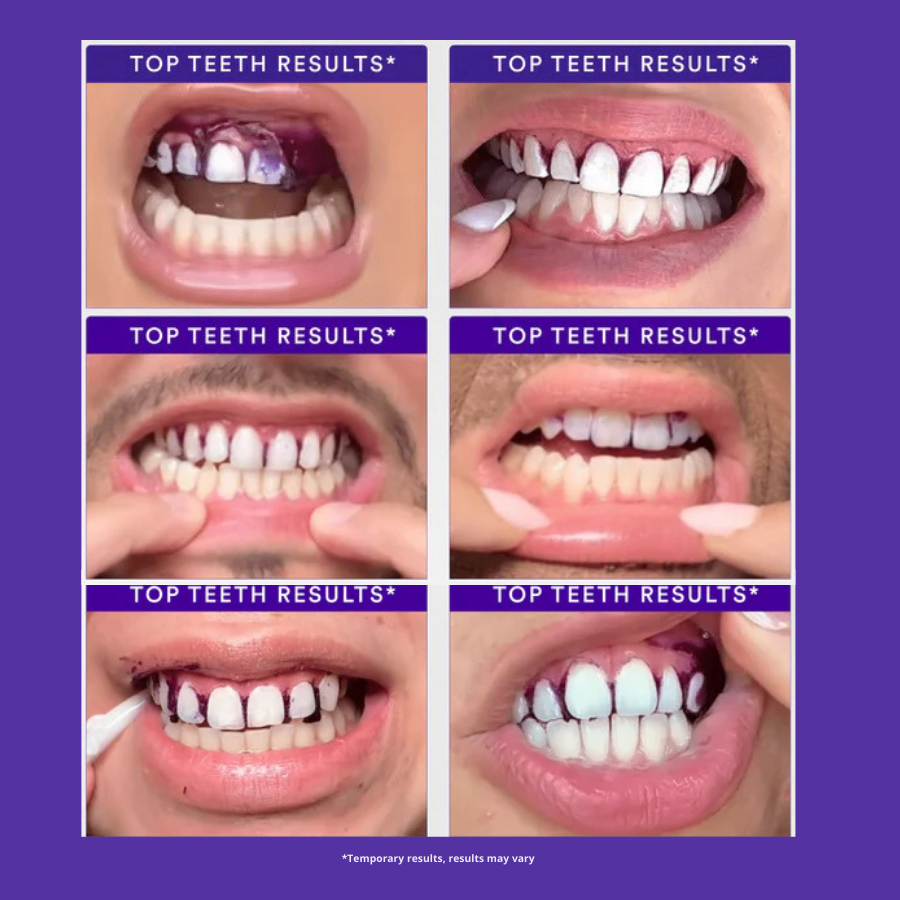 PurpleCorrect™ V34 Whitening Strips
